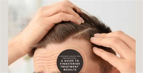 A Guide to Finasteride Treatment Results .